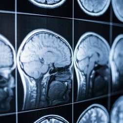 traumatic brain injury