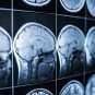traumatic brain injury