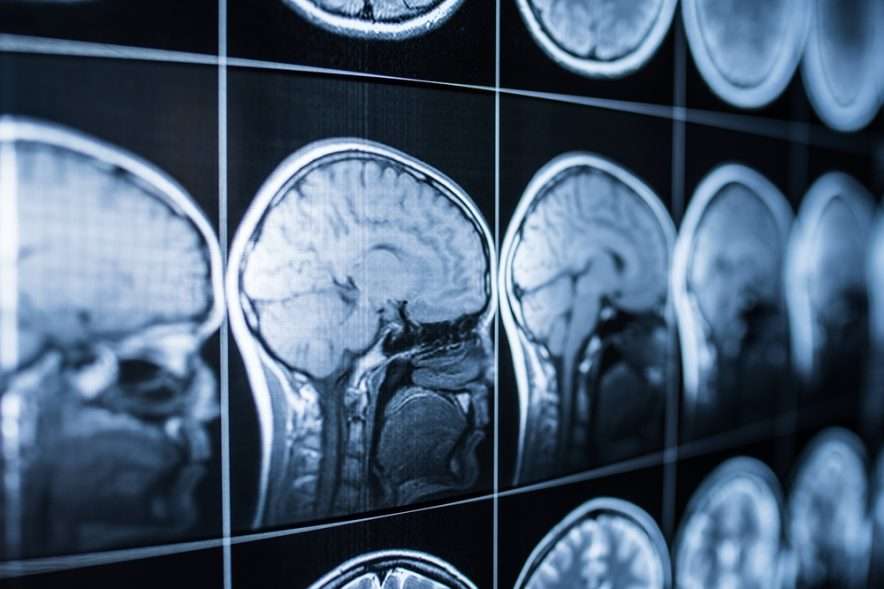 traumatic brain injury