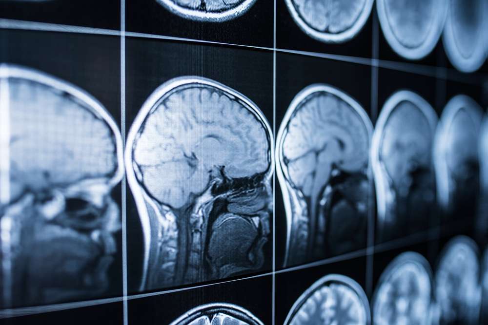 traumatic brain injury