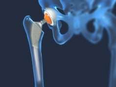 hip replacement