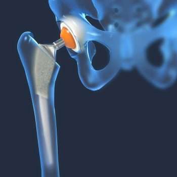 hip replacement