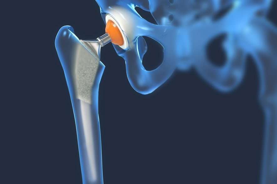 hip replacement